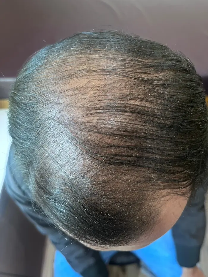 Male Pattern Baldness case 4 after treatment